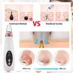 Electric Vacuum Electric Acne / Blackhead Remover Extractor 6 Suction Head Beauty Machine for Skin Care – Black Head Remover
